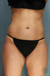 Coolsculpting Case 109 Before